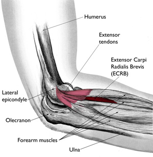 Arm showing Muscles and Tendon affected by Tennis Elbow